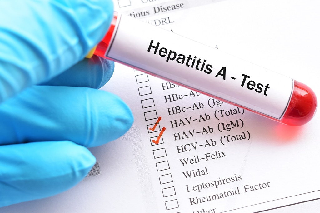 A型肝炎検査サンプルのクローズアップ