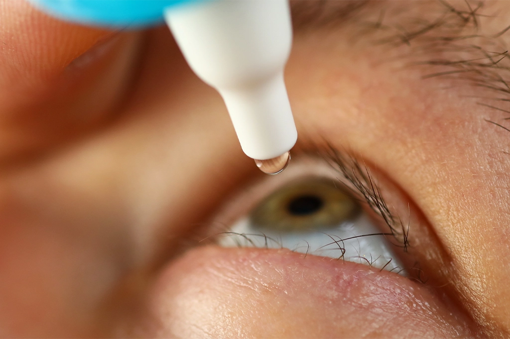 特写镜头拍摄一只眼睛向上凝视,一滴溶液正从蓝白相间的滴眼液瓶尖端滴入眼中。 特写镜头拍摄一只眼睛向上凝视,一滴溶液正从白色和蓝色的滴眼液瓶尖端滴入眼睛。.